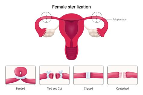 Tubal Ligation Guide: Permanent Birth Control Options