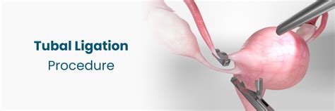Tubal Ligation Procedure: Your Comprehensive Overview