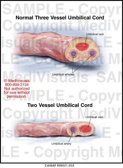 Two Vessel Cord