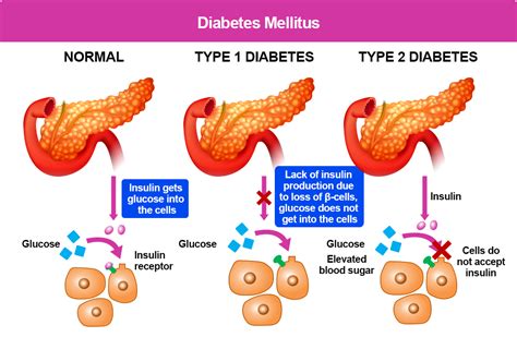 Type 1 Diabetes