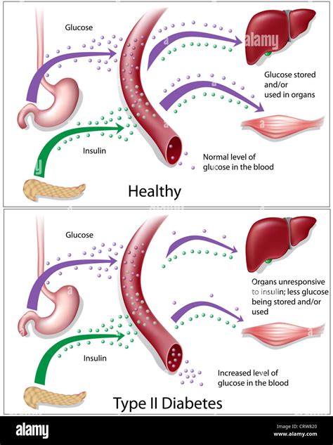 Type 2 Diabetes Glucose Levels: Manage With Ease