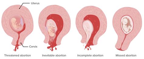 Types Of Abortion