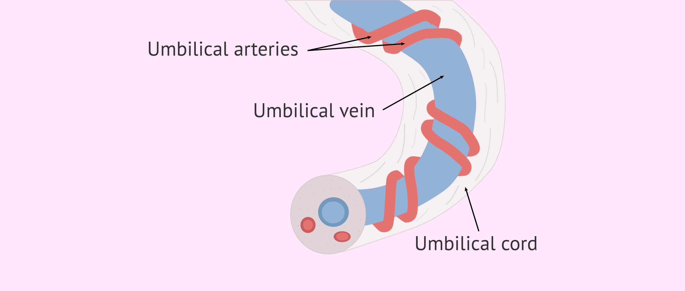 Umbilical Hernioplasty: Minimally Invasive Repair Solution