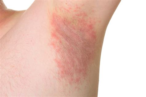 Underarm Yeast Infection