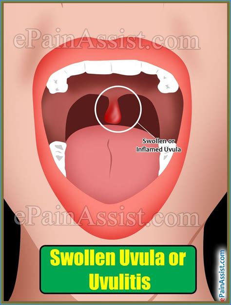 Uvula Swelling Causes Revealed