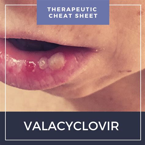 Valacyclovir Herpes Labialis Valacyclovir Herpes Labialis