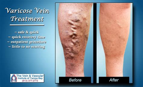 Varicose Vein Removal