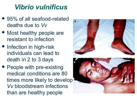 Vibrio Vulnificus Symptoms: Identify Early Warning Signs