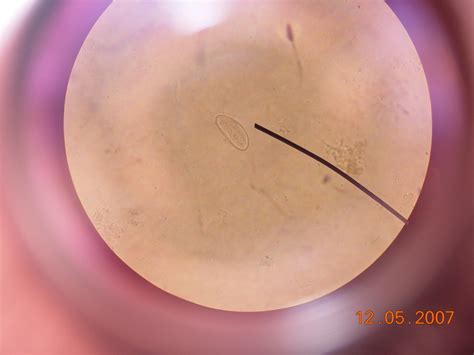 Visible Pinworm Eggs: Identify And Remove Easily