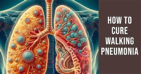 Walking Pneumonia Treatment Options
