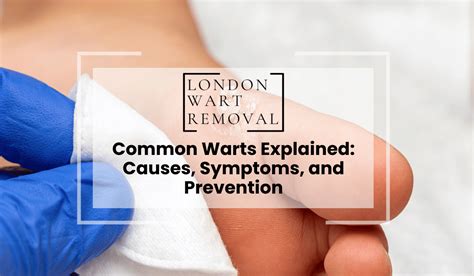 Wart Removal Guide: Causes & Cures