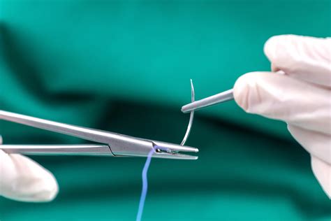 What Are Dissolvable Surgical Stitches? Healing Made Easy