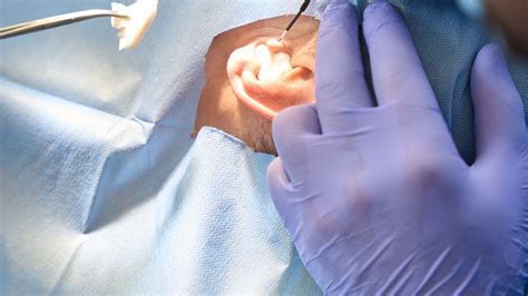 What Are Pe Tubes For Ears? Fast Relief Guide