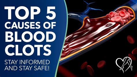 What Causes Blood Clots