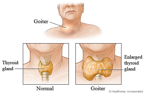 What Causes Goiter? Natural Remedies