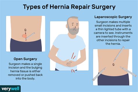 What Causes Inguinal Hernia? Repair Options