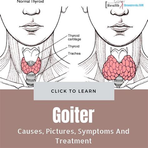 What Causes Of Goiter