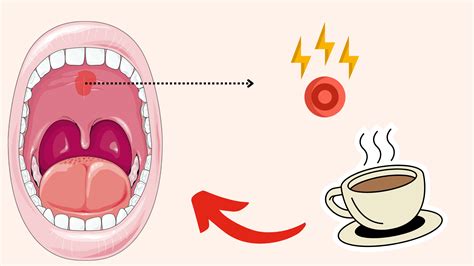 What Causes Roof Of Mouth Burn? Quick Relief Tips