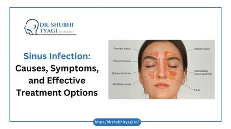 What Causes Sinus Infections? Effective Surgery Options
