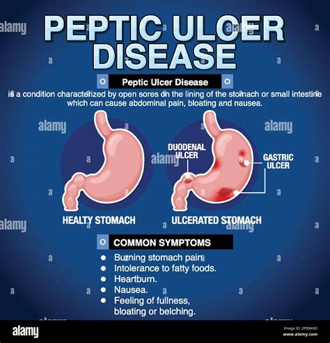 What Causes Stomach Ulcer In Esophagus? Healing Tips