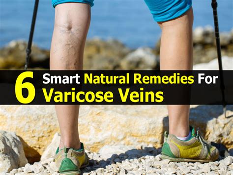 What Causes Varicose Veins? Natural Relief
