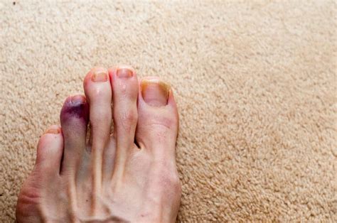 What Do Broken Toe Pictures Look Like? Identifying Symptoms