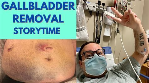 What Happens After Gallstone Surgery? Recovery Tips
