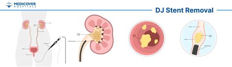 What Happens During Kidney Stent Removal? Easy Procedure