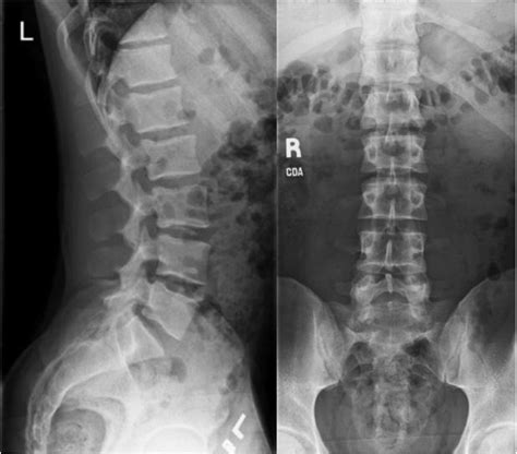 What Is A Lumbar Spine Xray Two Views Images