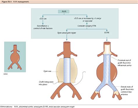 What Is Abdominal Aortic Aneurysm Surgery? Treatment Options