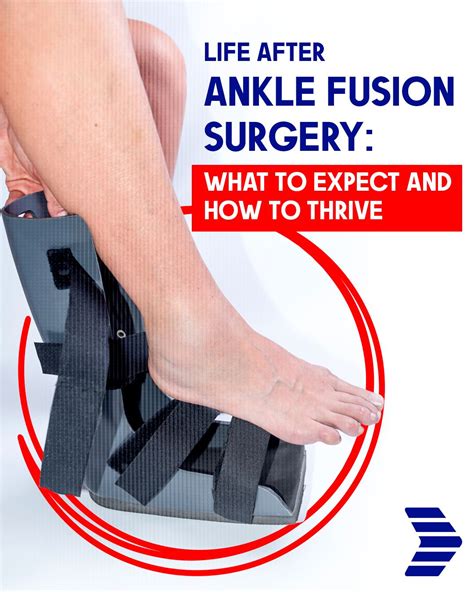 What Is Ankle Fusion Surgery? Recovery Guide