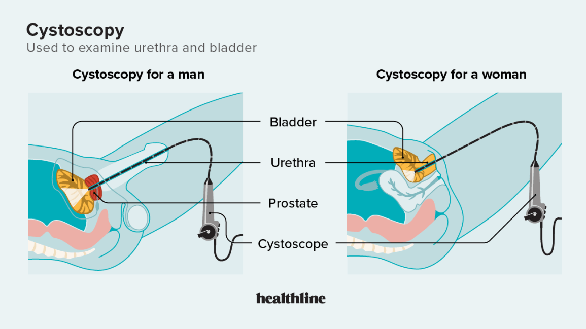 What Is Cystoscopy Urology Care Foundation What Is Cystoscopy Urology Care Foundation