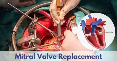 What Is Mitral Valve Repair? A Surgical Guide