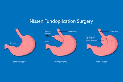 What Is Nissen Fundoplication Surgery? Relief Guide