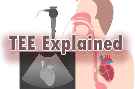 What Is Tee Echo Procedure? A Simple Explanation