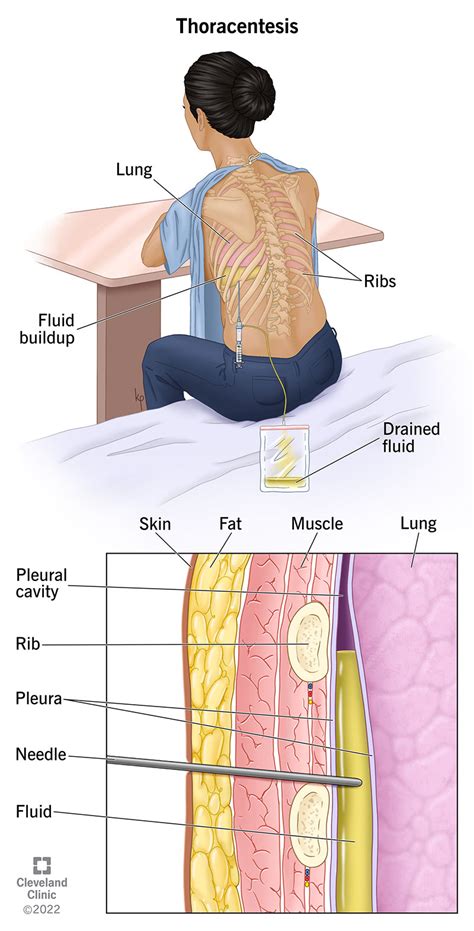 What Is Thoracentesis