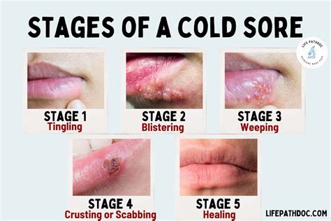 What Triggers Cold Sore Medicine Needs? Fast Relief
