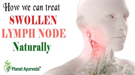 When Do Swollen Lymph Nodes Go Away? Natural Remedies