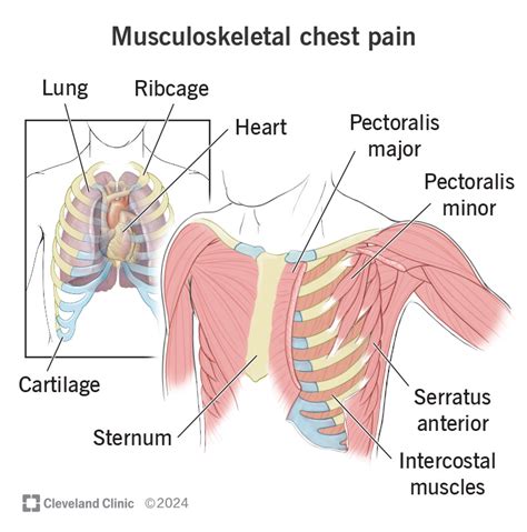 When Does Chest Pain Indicate Musculoskeletal Issues? Diagnostic Tips