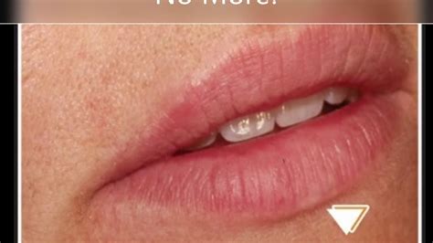 When Does Cold Sore Medicine Work Best? Quick Cure