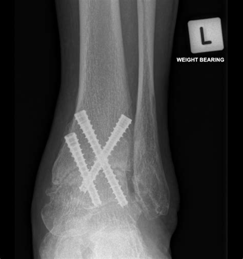 When Is Ankle Fusion Necessary? Surgical Options