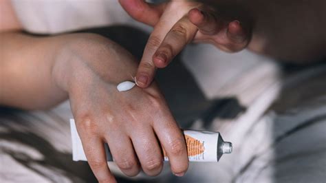 When To Use Triamcinolone For Eczema Relief?