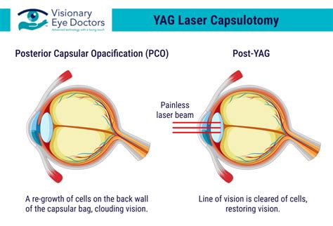 Yag Laser Capsulotomy